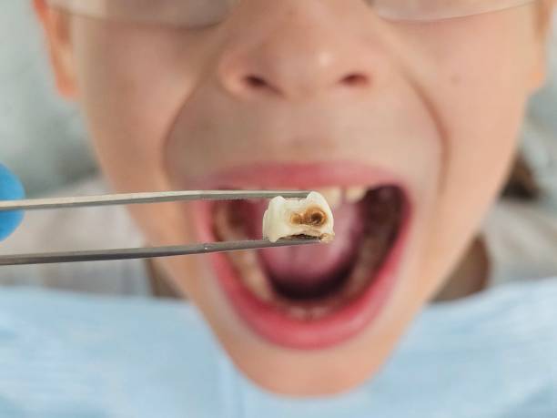 Best Dentist for Tooth Abscess  in Minden, LA